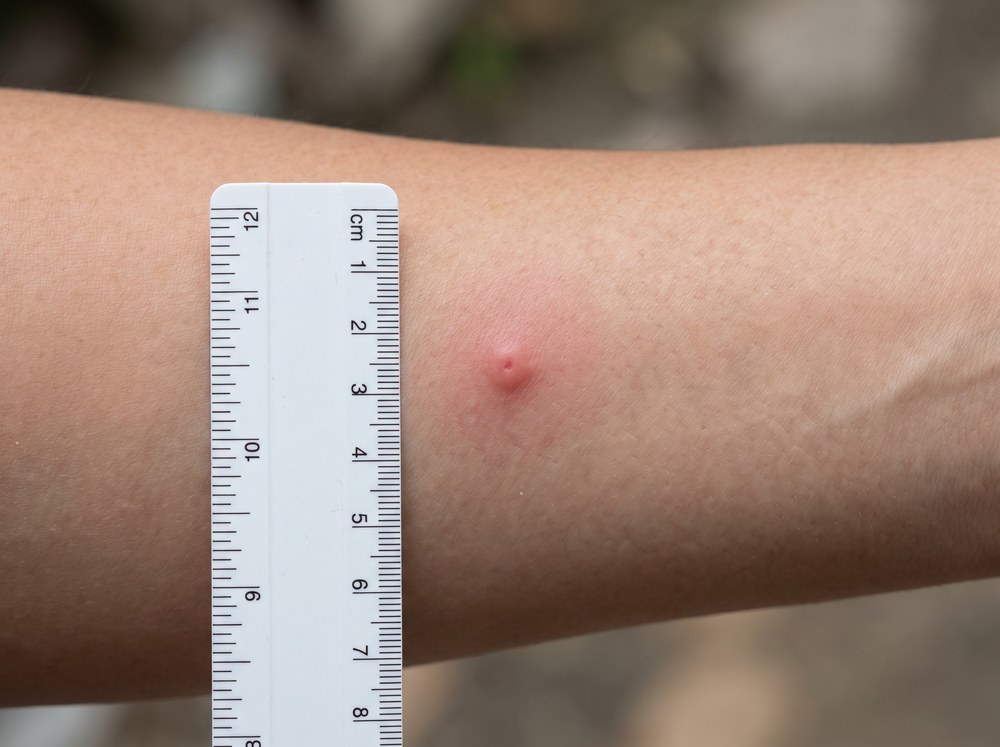 Close-up photo of a single bright red raised bite mark on a finger with mild surrounding swelling and no clustering