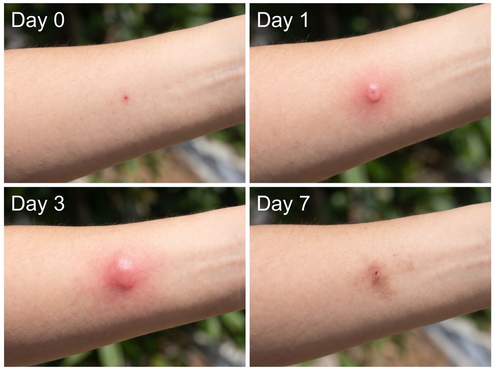 Four panel photo grid showing a cockroach bite mark fading from red and swollen on day zero to nearly healed by day seven